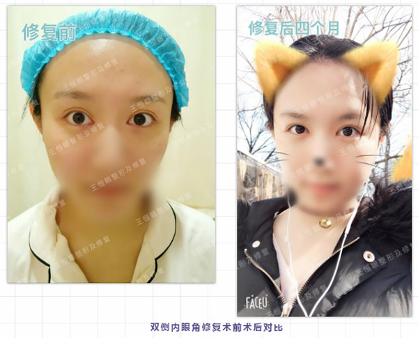 我的內(nèi)眼角修復(fù)成功了,是北京睞美安王恒醫(yī)生修復(fù)的 18款禁用看黄入口gα