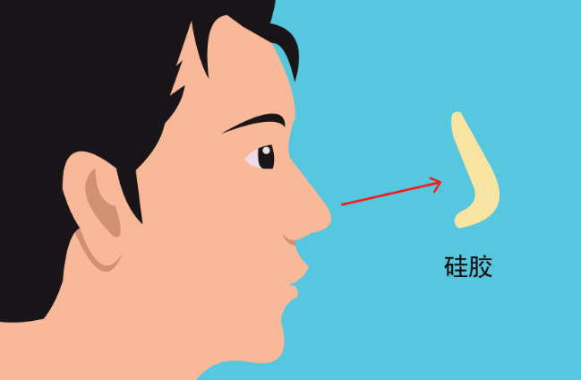 廣州羅勇做鼻子貴嗎?通過技術優勢對他隆鼻手術費用估算 羞羞答答国精产品免费