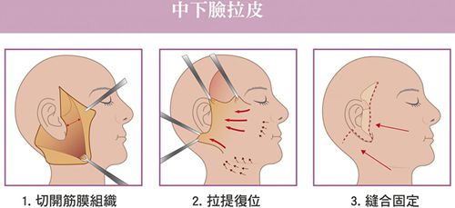 北京大拉皮哪個大夫做的好?大拉皮醫生排名前十中前五名做大拉皮手術尤其好 亚洲133在线