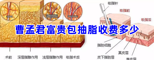曹孟君富貴包抽脂收費價格7900-2.9萬,土麥生/水動力/微創吸脂價格不同 3000看黄禁用免费入口