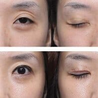 切開雙眼皮需要1000-10000元,價格卻有很大的問題 红杏无吗区区三区四区免费看